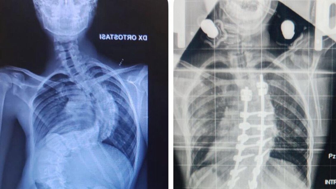 Operato con successo un 13enne affetto da grave scoliosi di 117 gradi a Bari