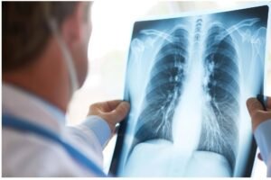 Curare il cancro al polmone senza chirurgia: prima italiana all'Ieo di Milano