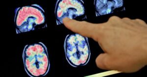 Alzheimer: uno studio italiano rivela come la stimolazione transcranica blocca le placche