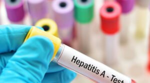 Epatite A: allerta sulle tre regioni più colpite, inclusa la Puglia
