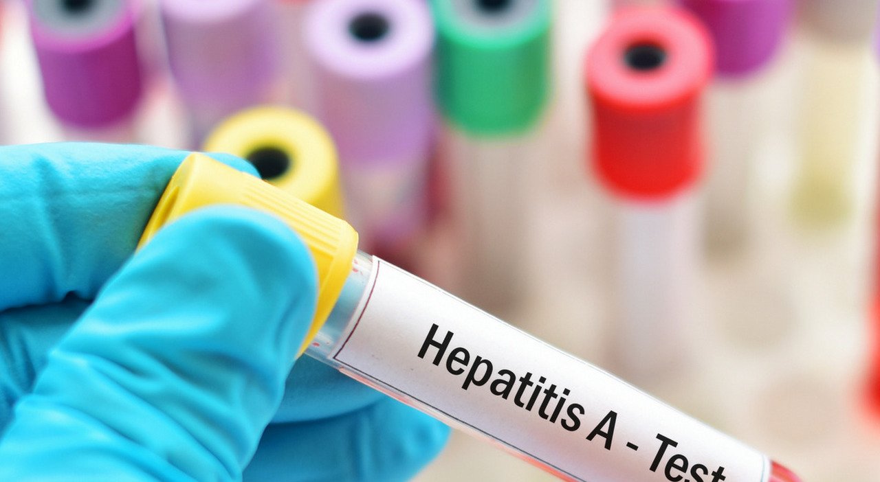 Epatite A: allerta sulle tre regioni più colpite, inclusa la Puglia
