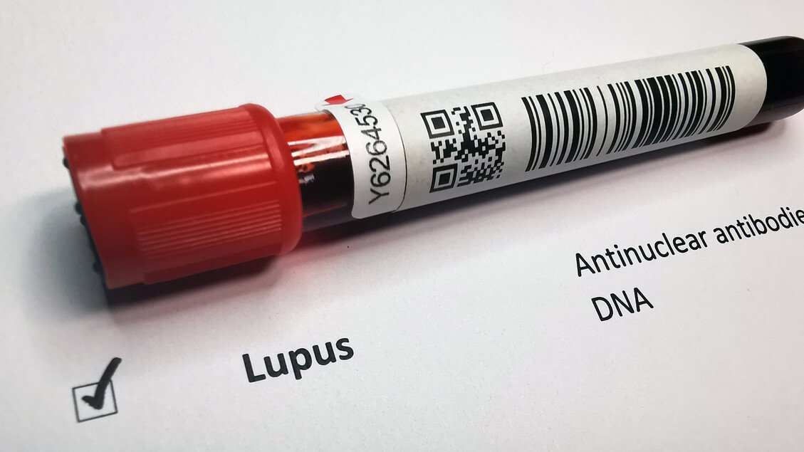 Lupus: 23 mila colpiti in Italia e una diagnosi lunga 4-6 anni, avviato un registro.